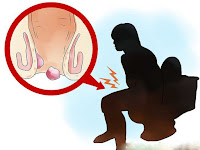 Cara Mengobati Penyakit Anus Fistula