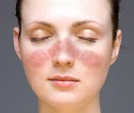 Sep 01, 2010 - Systemic lupus