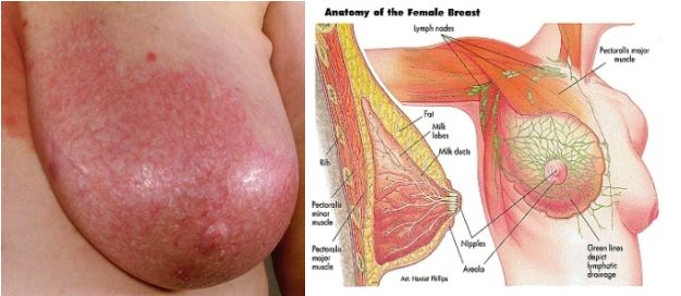 Breast Mastitis Infection Disease