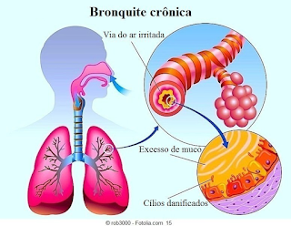 Saiba tudo sobre Bronquites