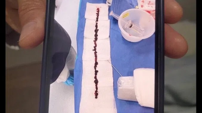 Video: 10-Inch Clot Removed From Live Vaccinated Person – Doctors Baffled