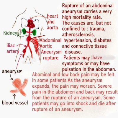 aortic aneurysm symptoms. trauma aortic aneurysm