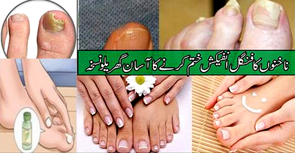 Fungal Toe Nail, Cure By Home Remedies