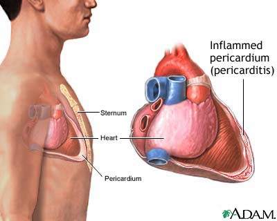 heart attack pain. after a heart attack,