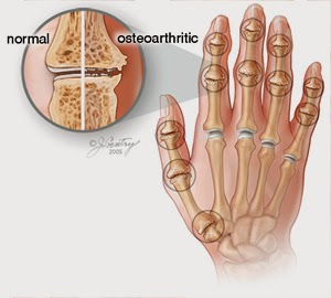 Cara Mengobati Osteoarthritis