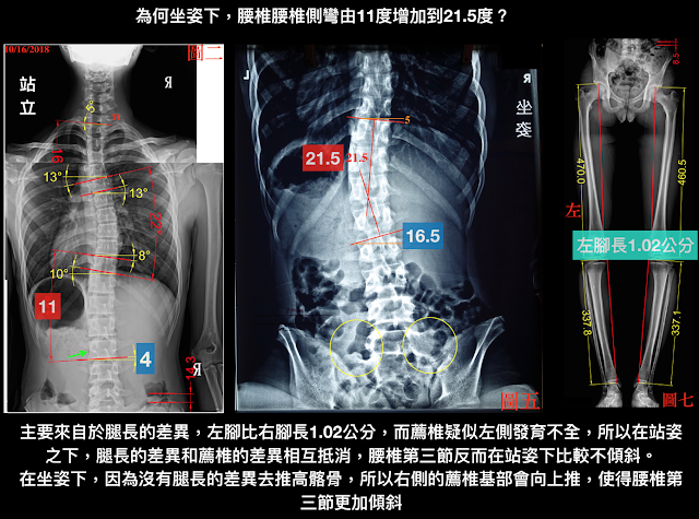 脊椎側彎檢查, 脊椎側彎度數, 脊椎側彎矯正, 脊椎側彎治療, 脊椎側彎矯正運動, 脊椎側彎 物理治療, 脊椎側彎 推薦, 脊椎側彎 台中, 脊椎側彎矯正成功案例