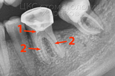 рентген с некачественной пломбировкой корневых каналов