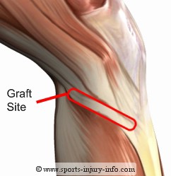 anterior cruciate ligament rupture is osteoarthritis inevitable