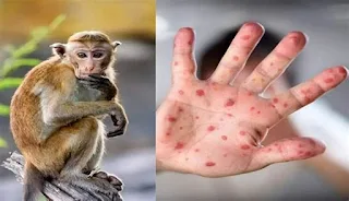Dinkes Cimahi Imbau Warga Waspada Terhadap Potensi Penyebaran Cacar Monyet