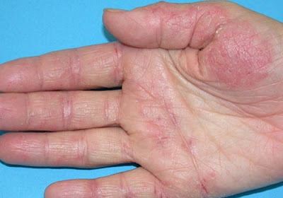 Điều trị nấm da tay bằng đông y có thực sự hiệu quả?-2