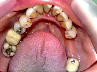 Karies gigi bisa sebabkan bau mulut