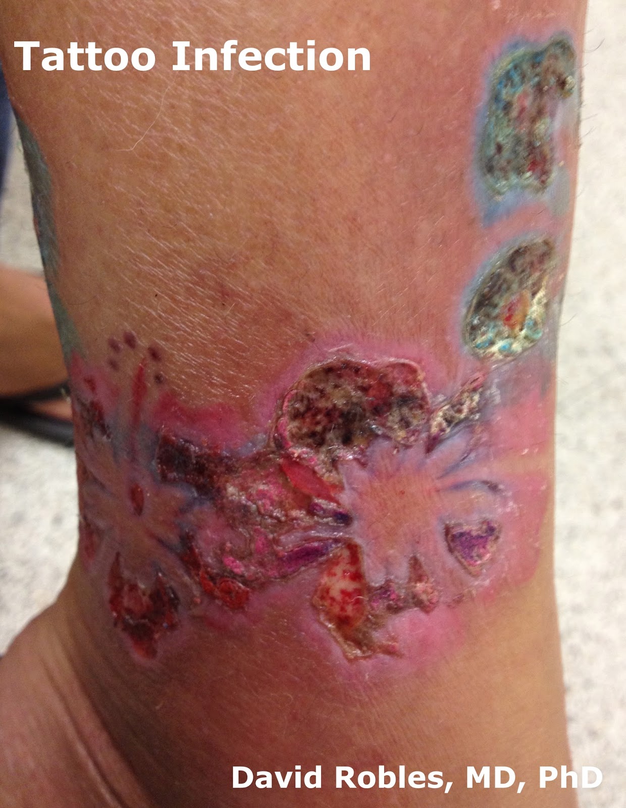 Tattoo Reactions: Allergic Contact Dermatitis By David ...