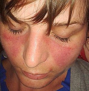 Autoimmune disorder - Butterfly like rash found in the face