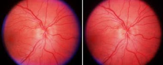 Ischaemic Optic Neuropathy