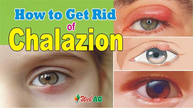 How To Get Rid of Chalazion | Chalazion Natural Remedies