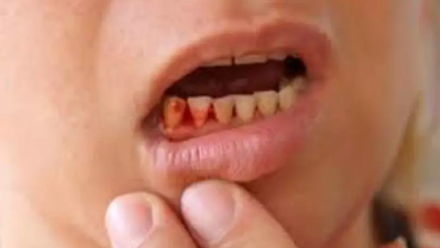 treatment of bleeding gums, reasons behind the bleeding gums