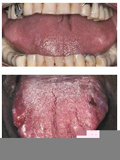 Metabolic and Genetic Disorders Amyloidosis