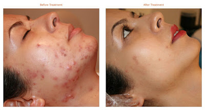 3 Steps to Cost-Effective Acne Scar Removal