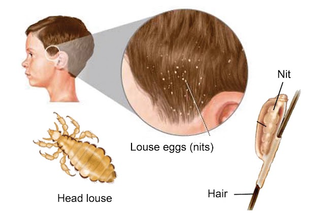 Body Lice or Pediculosis: Natural Herbal Treatment 