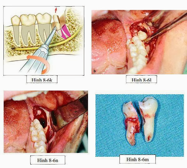 nhổ răng 8 nghiêng