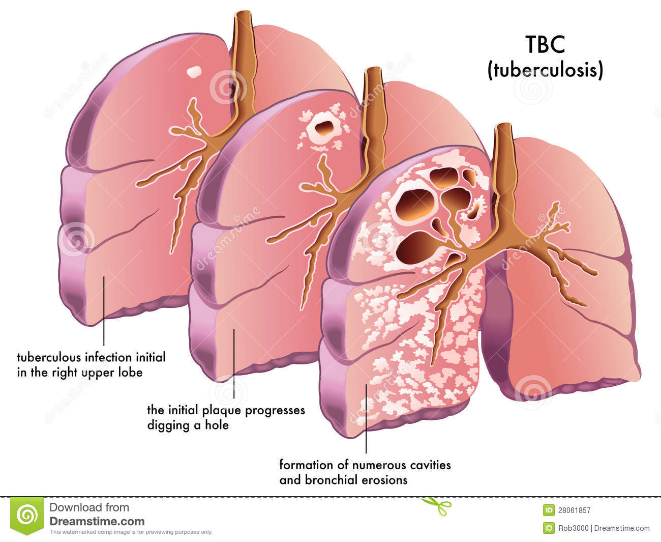 Ubat Tonsil Bayi - Contoh Top