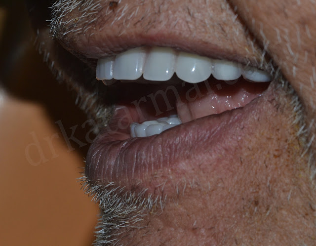 After Treatment of Teeth Supported Overdenture