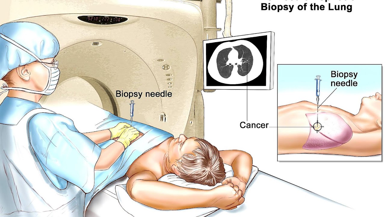 Small Cell Lung Cancer Alternative Treatments