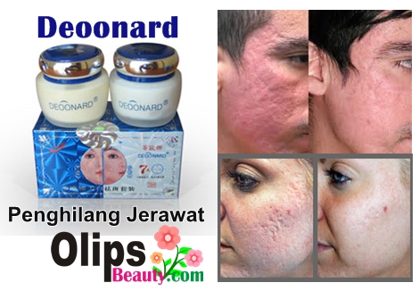 Cream Khusus Penghilang Jerawat Deoonard 7 Days