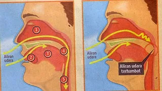 Bahaya Tidur Ngorok Mendengkur