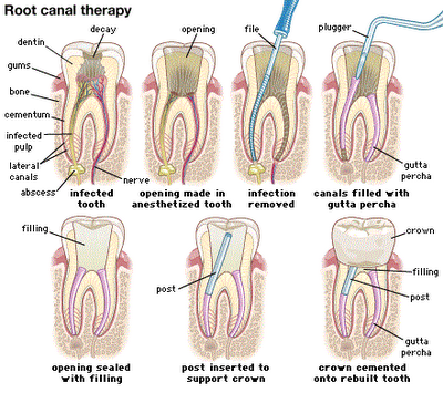 Rawatan Matikan Akar Gigi/ Root Canal Treatment di klinik 
