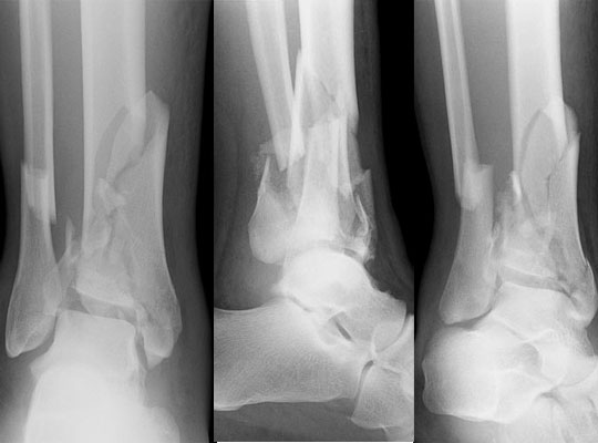 Pilon Fracture Treatment | Pilon Bone Fracture Surgery