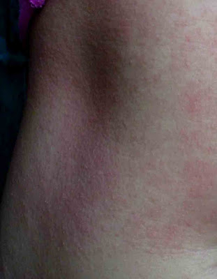 heat rashes pictures. toddler heat rash pictures.