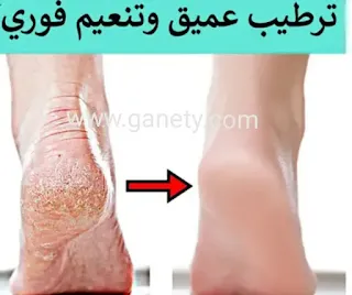 علاج تشققات القدمين في يوم واحد فقط مجرب وفعال