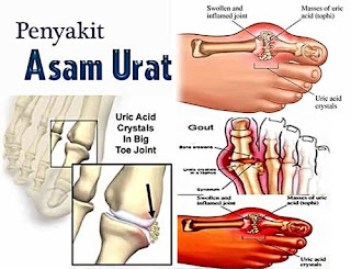 Cara Mengobati Sakit Asam Urat Tradisional, Air Kelapa Untuk Asam Urat Dan Kolesterol, Askep Teoritis Asam Urat, Obat Asam Urat Yang Sangat Ampuh, Bila Asam Urat Rendah, Asam Urat Voltaren, Air Kelapa Meningkatkan Asam Urat, Obat Menghilangkan Rasa Nyeri Asam Urat, Cara Untuk Mencegah Penyakit Asam Urat, Obat Asam Urat Alami Yang Manjur, Asam Urat Terapi, Bolehkah Penderita Asam Urat Makan Nanas, Apa Penyebab Asam Urat Kambuh, Mengobati Asam Urat Dengan Kumis Kucing, Cara Buat Obat Tradisional Asam Urat, Tanda Asam Urat Di Kaki, Mengenal Gejala Asam Urat, Obat Asam Urat Ibu Menyusui, Asam Urat Tangan, Pengobatan Tradisional Kolesterol Dan Asam Urat, Nama Generik Asam Urat, Obat Alami Buat Asam Urat Dan Kolesterol, Cara Mengatasi Asam Urat Di Usia Muda, Asam Urat Rendam Air Hangat, Cara Mengobati Asam Urat Dg Obat Tradisional, Penanganan Bengkak Asam Urat, Asam Urat Boleh Dipijat Atau Tidak, Pengobatan Pada Penyakit Asam Urat, Pantangan Asam Urat Kangkung, Menurunkan Asam Urat Secara Herbal 