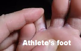 Athlete's foot Monsoon Skin Care in Hindi