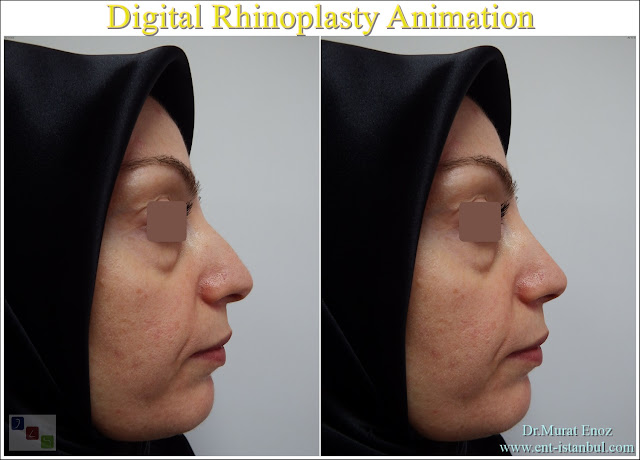 Rhinoplasty animation, Digital nose aesthetics animation, Virtual nose aesthetics, Nose aesthetic operation simulation, Digital nose imaging