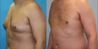 صورة تضخم الثدي عند الرجال