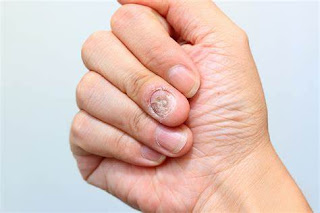 nail toe fungus treatment