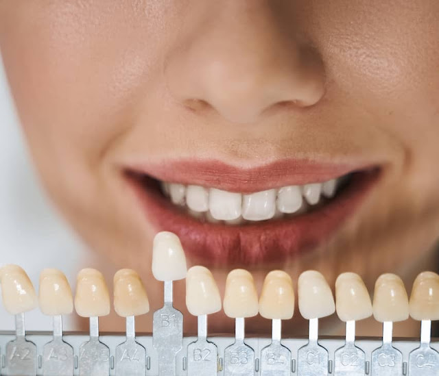 Donna di 34 anni con la bocca aperta che confronta il colore dei suoi denti con quello delle corone in zirconia