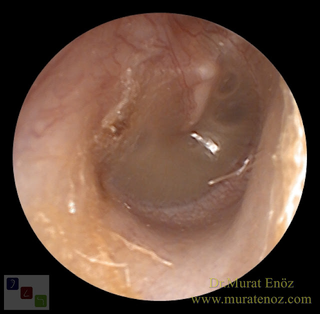Sessiz orta kulak iltihabı tanımı - Sessiz orta kulak iltihabı terminoloji - Kronik sessiz orta kulak iltihabı - Sessiz orta kulak iltihabı nasıl ortaya çıkar? - Östaki tüpü ile ilgili sorunlar, orta kulak sıvılarında en sık neden olarak görülmektedir - Efüzyonlu otitis media mutlaka akut otitis mediayı takiben ortaya çıkmaz! - Yarık damak olan hastalarda, sessiz orta kulak iltihabı ortaya çıkabilir! - Sessiz orta kulak iltihabı için risk faktörleri - Düzeltilmiş yanlış bir ifade "orta kulak sıvısı dışarıdan kulağa sıvı kaçmasıyla ortaya çıkmaz" - Sessiz orta kulak iltihabı nasıl seyreder? - Sessiz orta kulak iltihabının belirtileri - Sessiz orta kulak iltihabının tanısı - Sessiz orta kulak iltihabı tedavisi - Çocuğunuzda sessiz orta kulak iltihabını nasıl önleyebilirsiniz? - Sessiz orta kulak iltihabı komplikasyonları - Maskeli orta kulak iltihabı - Effüzyonlu otitis media - Sekretuar otitis media - Seröz otitis media - Silent otitis media - Masked otitis media - Serous otitis media - Otitis media with effusion (OME)