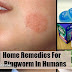 Home Remedies For Ringworm