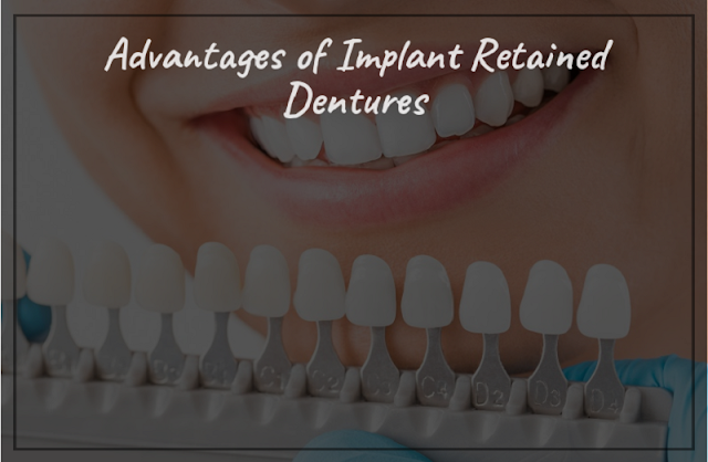 Advantages of Implant Retained Dentures