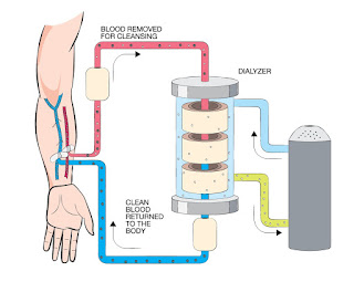 Peritoneal Dialysis