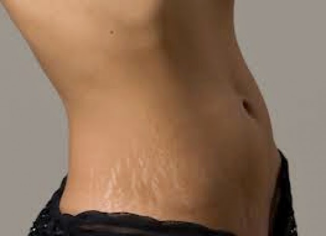 10. How To Get Rid Of Stretch Marks