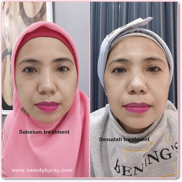 before after benings clinic