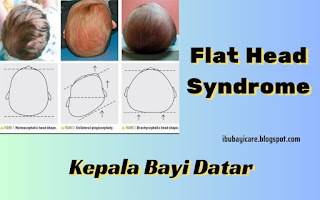 Flat Head Syndrome, Memperbaiki Kepala Bayi Datar