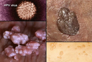 3 vCara menghilangkan daging tumbuh di lubang anus dan terasa gatal bintik kecil