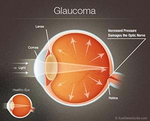 Cara menyembuhkan penyakit glaukoma