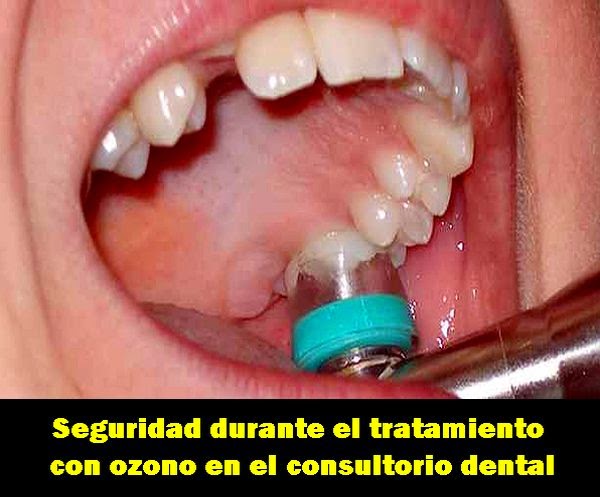 PDF: Seguridad durante el tratamiento con ozono en el Consultorio Dental