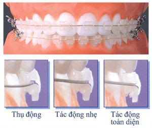 Niềng răng mắc cài sứ tự động - mô hình